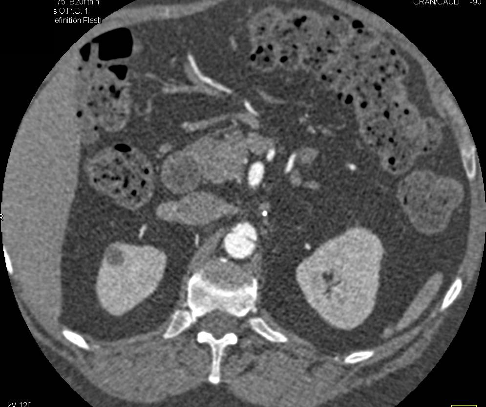 Ehlers-Danlos with Iliac Artery Replacement and Hepatic Artery Aneurysm - CTisus CT Scan