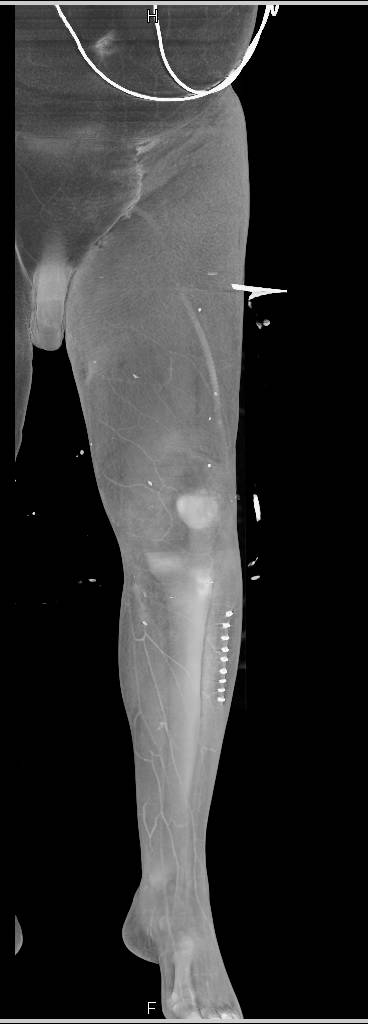 CTA Runoff with Bypass Grafts Seen - CTisus CT Scan