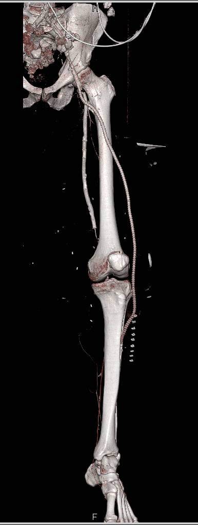 CTA of Superficial Femoral Artery (SFA) to Anterior Tibial Artery Bypass - CTisus CT Scan