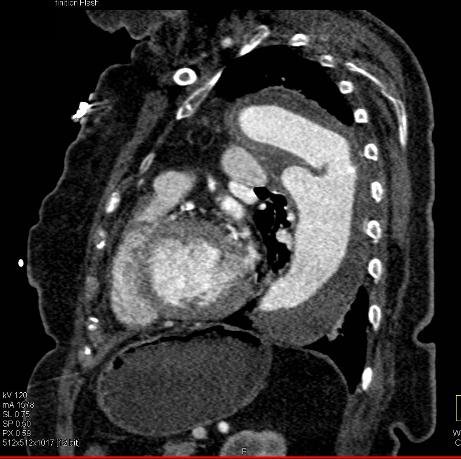 Complex Arch Repair with Endoleak - CTisus CT Scan