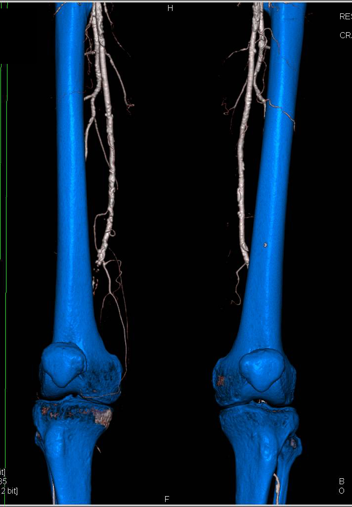 Dual Energy Run-off Study with Peripheral Vascular Disease - CTisus CT Scan