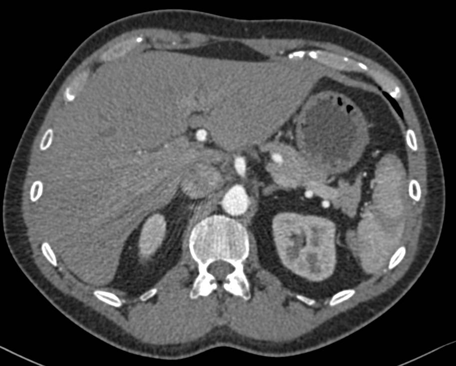 Hepatic Artery Aneurysm - CTisus CT Scan