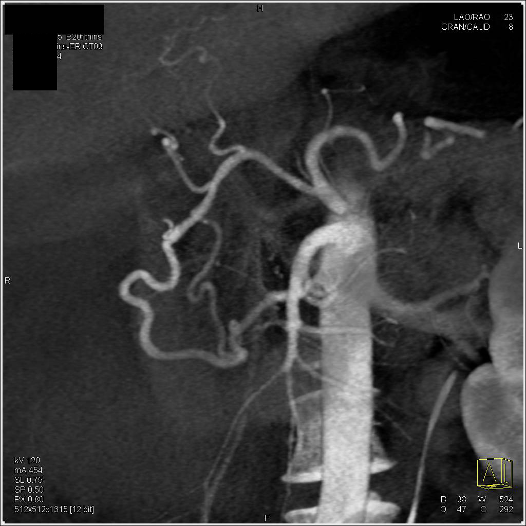 Prominent Gastroduodenal Artery (GDA) with Bleed and Then Embolization of GDA (3 separate datapoints are shown) - CTisus CT Scan