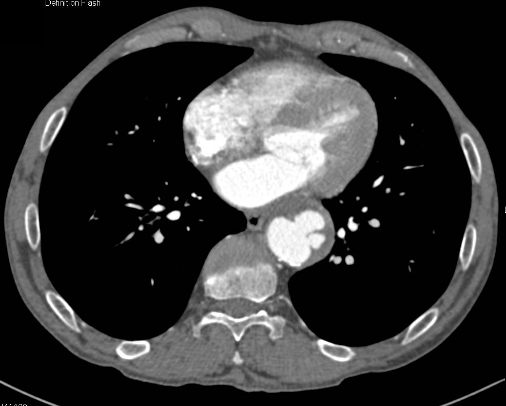 Ulceration in Descending Thoracic Aorta - CTisus CT Scan