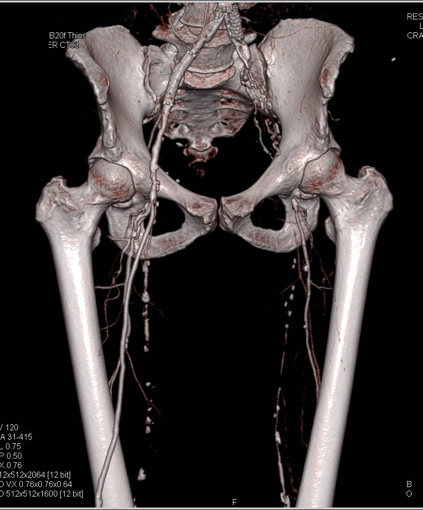 Runoff with Severe Peripheral Vascular Disease (PVD) with Occluded Left External Iliac Artery - CTisus CT Scan