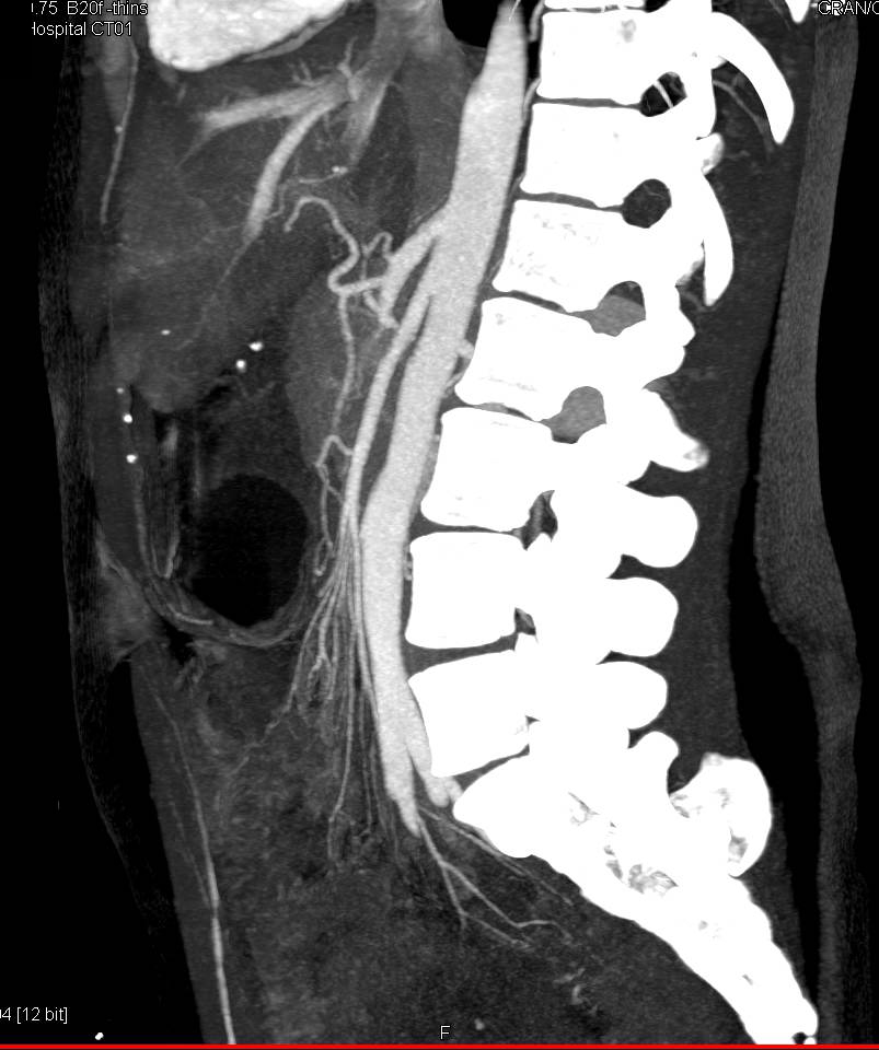 Superior Mesenteric Artery (SMA) Syndrome with Narrow SMA-Aorta Angle ...