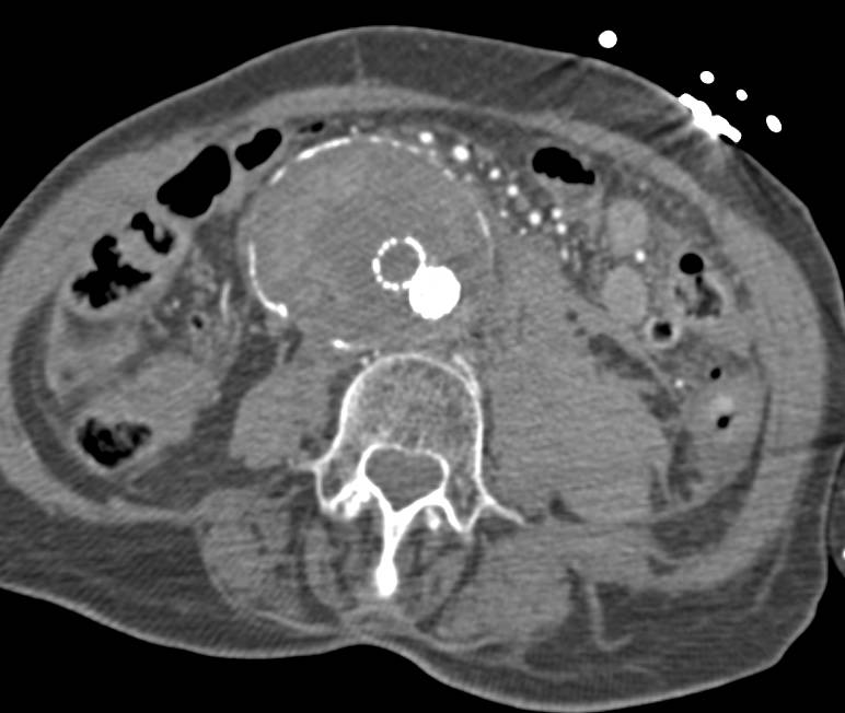 Endovascular Stent with Occluded Limb and Retroperitoneal Bleed - CTisus CT Scan