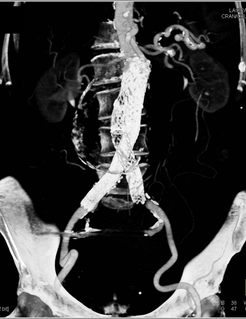 Endovascular Stent with Occluded Limb and Retroperitoneal Bleed - CTisus CT Scan