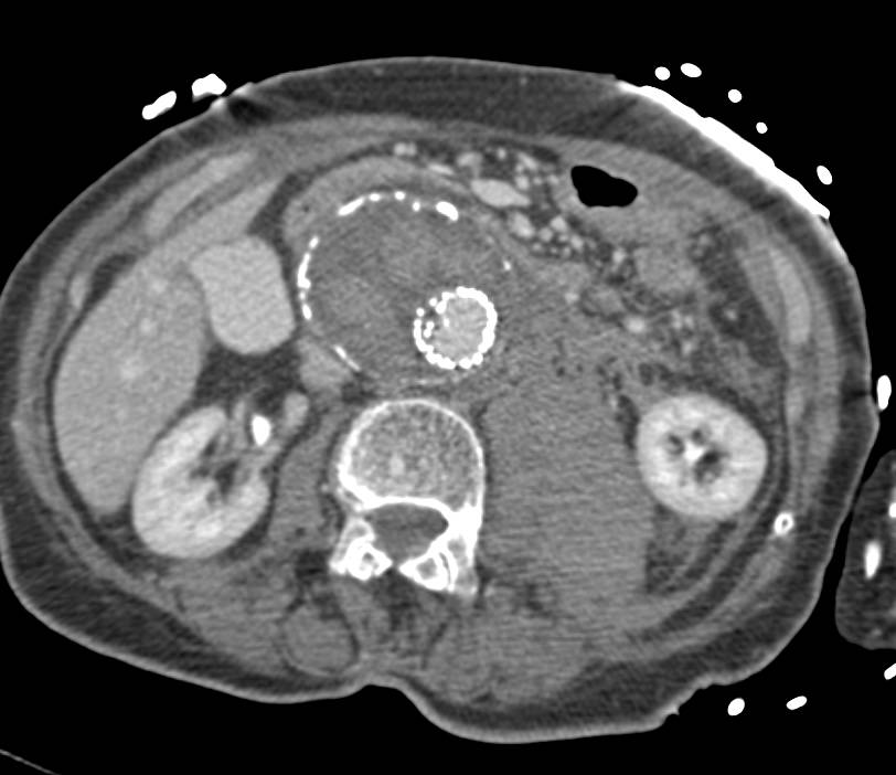 Retroperitoneal Bleed from a Leaking Aneurysm - CTisus CT Scan