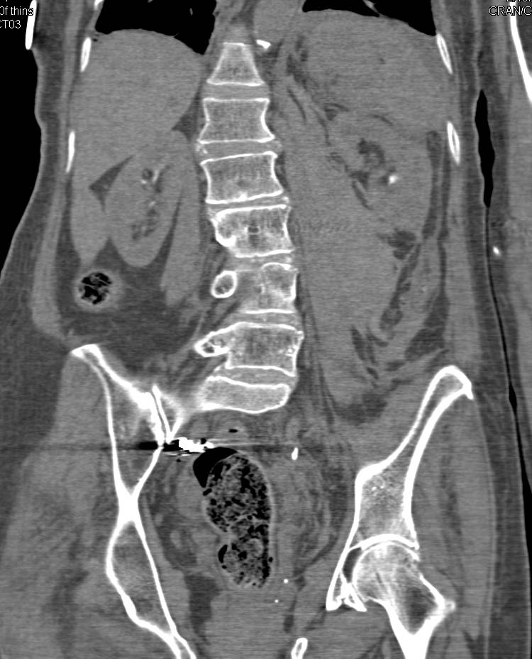 Endovascular Stent with Occluded Limb - CTisus CT Scan