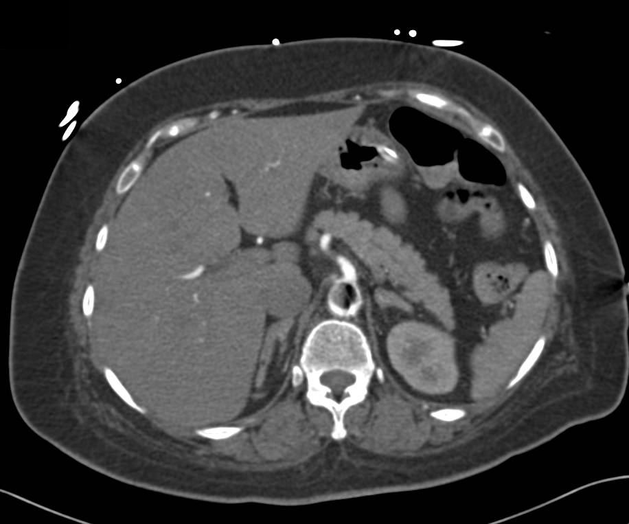 Artifact Caused by Intra-Aortic Balloon Pump - CTisus CT Scan