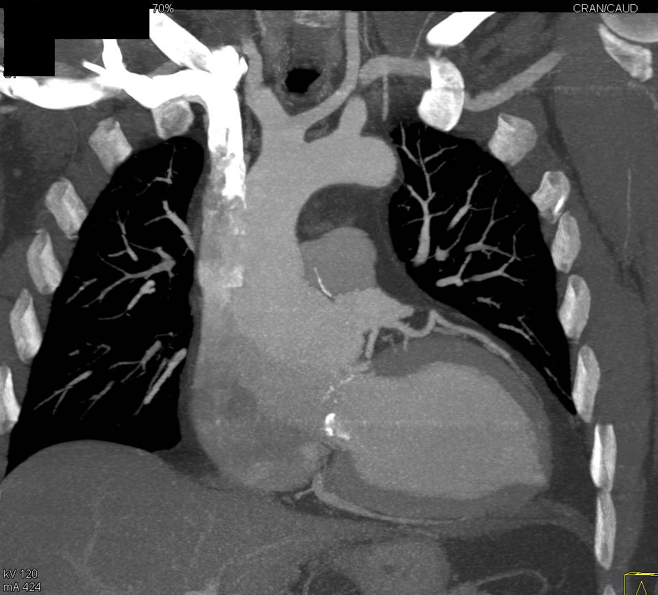 Type A Dissection - CTisus CT Scan