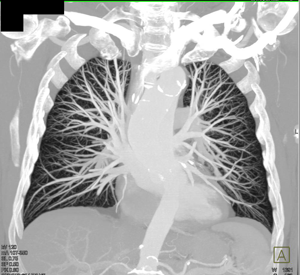 MIP of Normal Pulmonary Vasculature - CTisus CT Scan