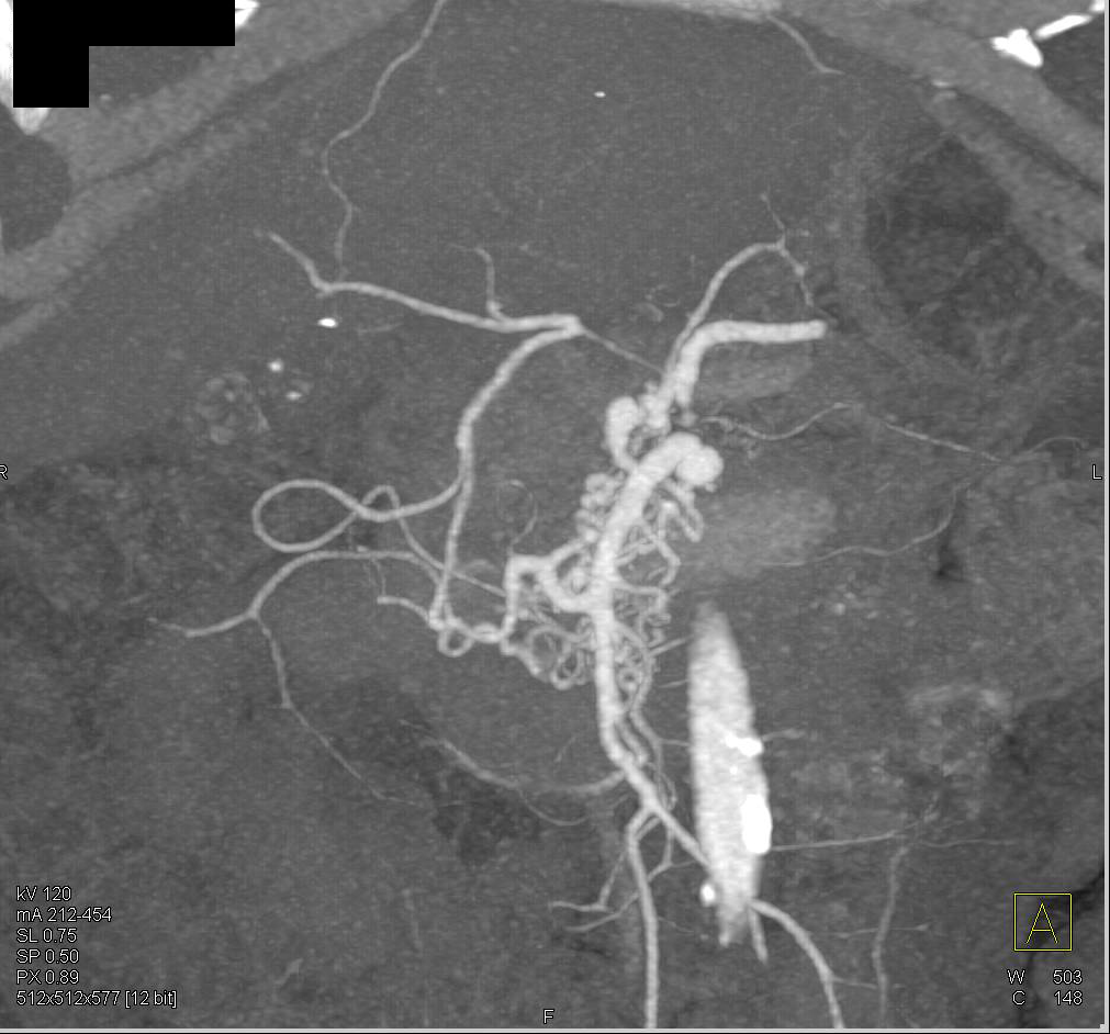 Multiple Collaterals off the SMA - CTisus CT Scan