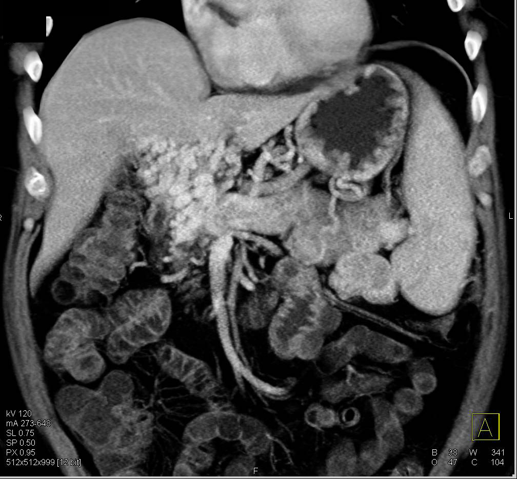 Cavernous Transformation of the Portal Vein in Cirrhotic Liver - CTisus CT Scan