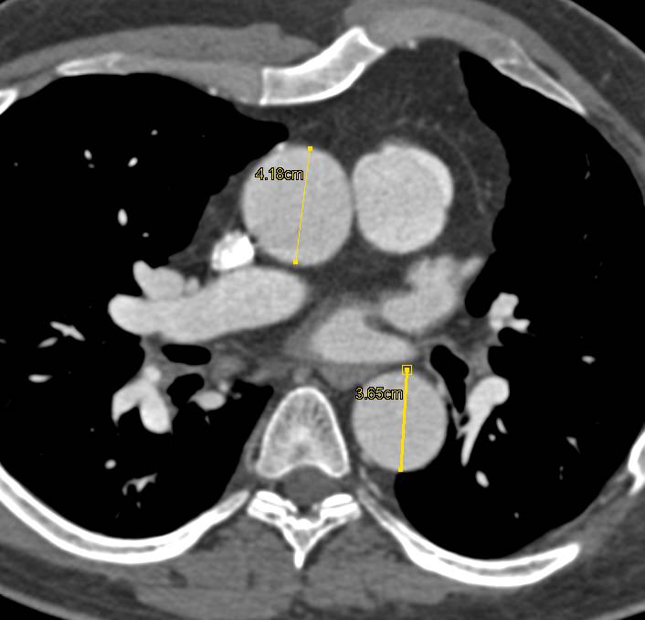 Coarctation of the Aorta Repaired with a Stent - CTisus CT Scan