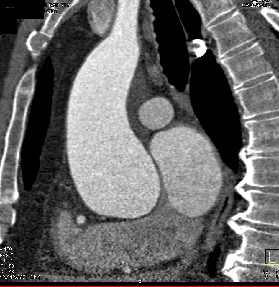 Dilated Aortic Root in Marfan Syndrome - CTisus CT Scan