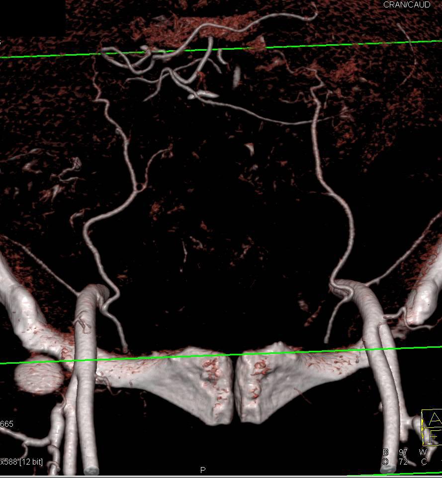 3D of Superficial Femoral Artery (SFA) Vascular Map - CTisus CT Scan