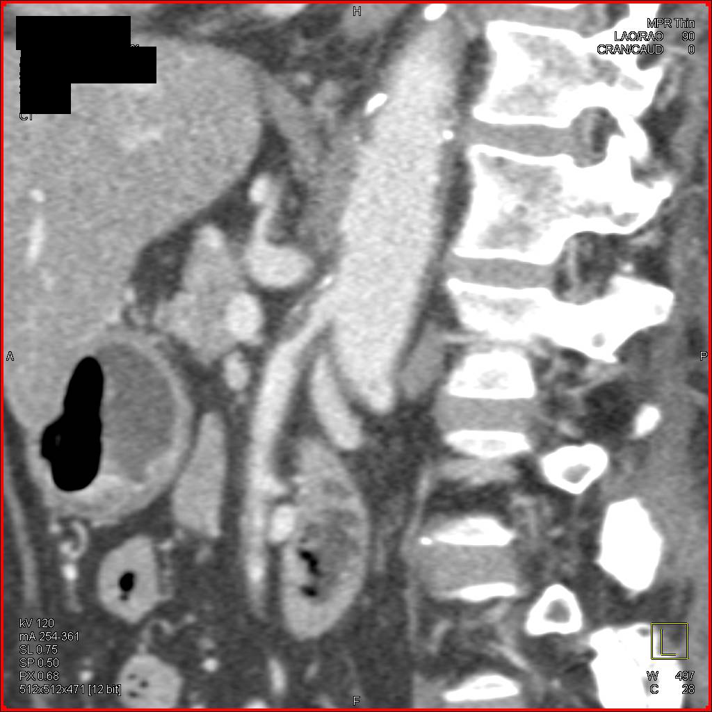 Superior Mesenteric Artery (SMA) Stenosis due to Calcified and Non-Calcified Plaque - CTisus CT Scan