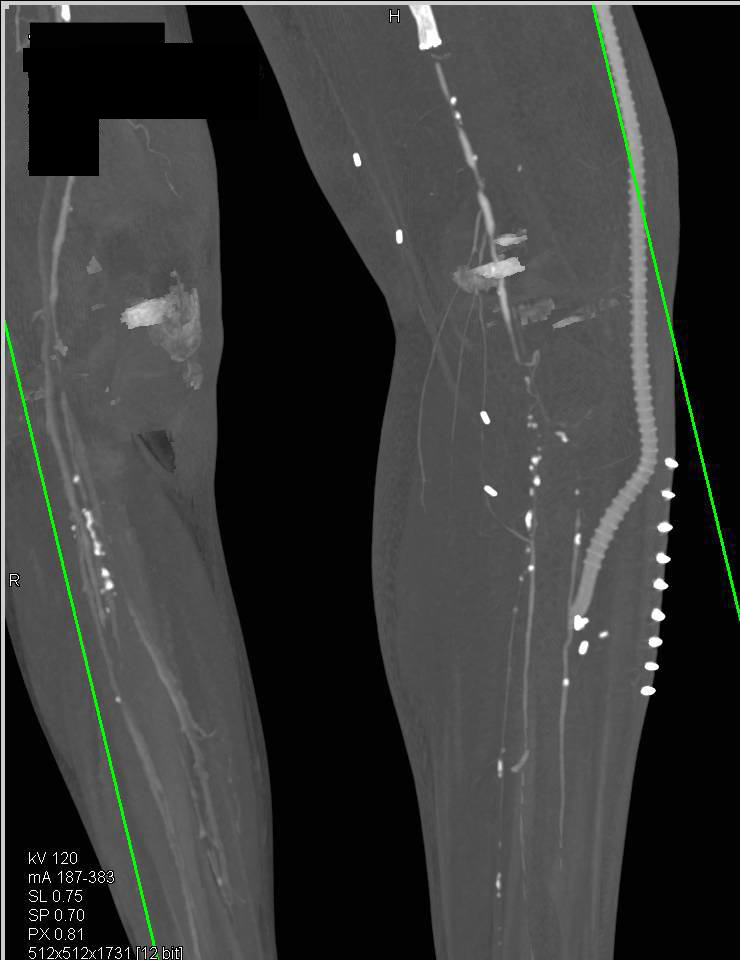 CTA Runoff Lower Extremities with Multiple Stents - CTisus CT Scan