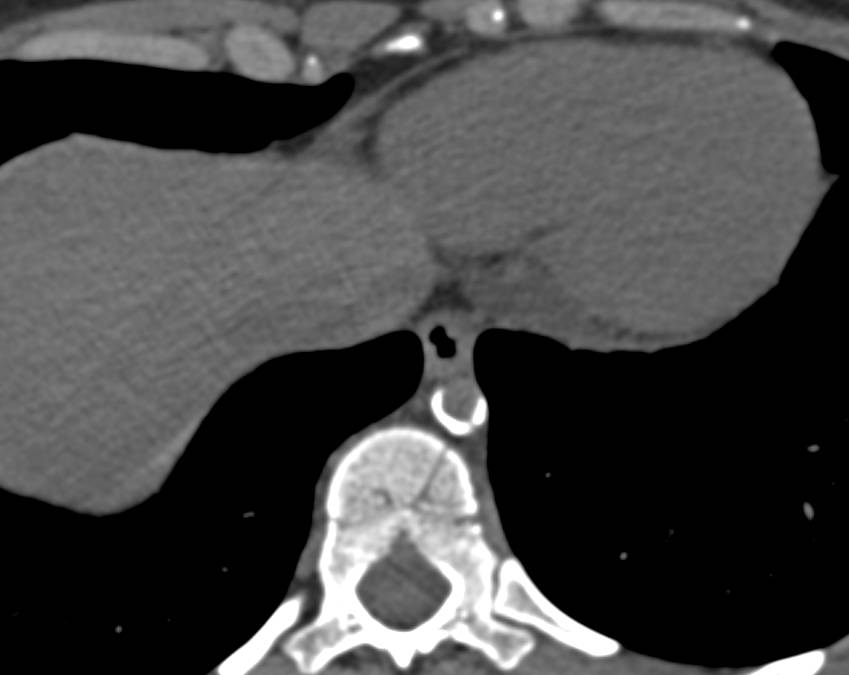 Narrowed and Partially Calcified Upper Abdominal Aorta Probably a Sequelae of Prior Trauma - CTisus CT Scan