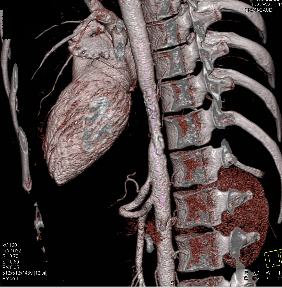 Stenosis of Upper Abdominal Aorta Probably due to Prior Trauma - CTisus CT Scan