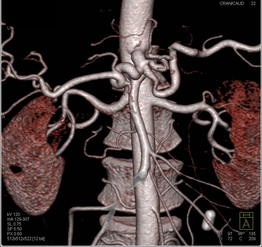 CTA of Mesenteric Vessels with Splenic Artery Stenosis - CTisus CT Scan