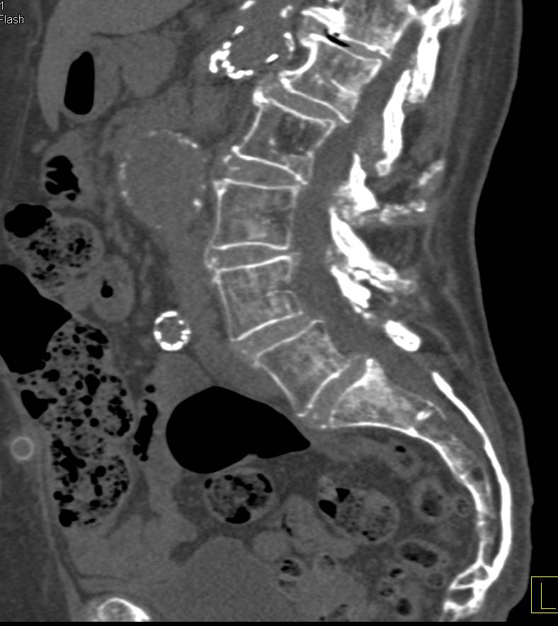 Endovascular Stent with Fem-Fem Bypass Also Seen - CTisus CT Scan