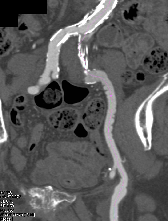 Endovascular Stent with Endoleak and Graft Stenosis - CTisus CT Scan