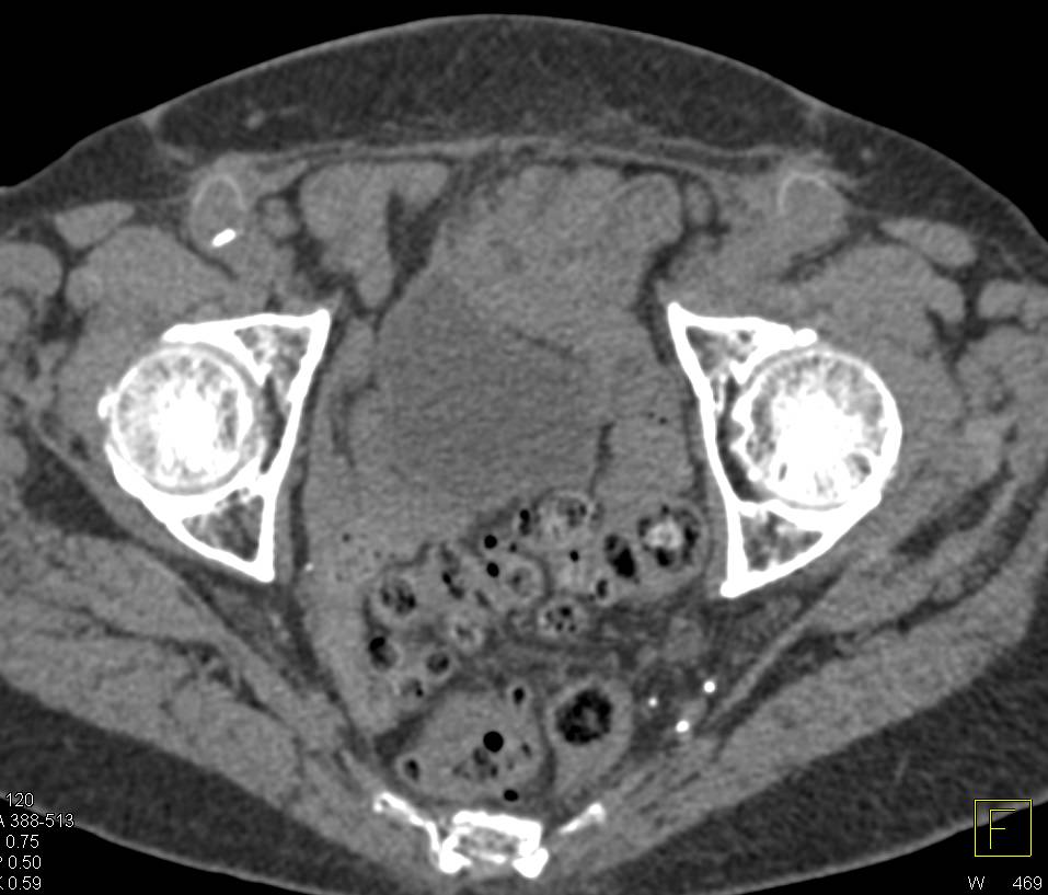 Endovascular Stent with Fem-Fem Bypass Also Seen - CTisus CT Scan