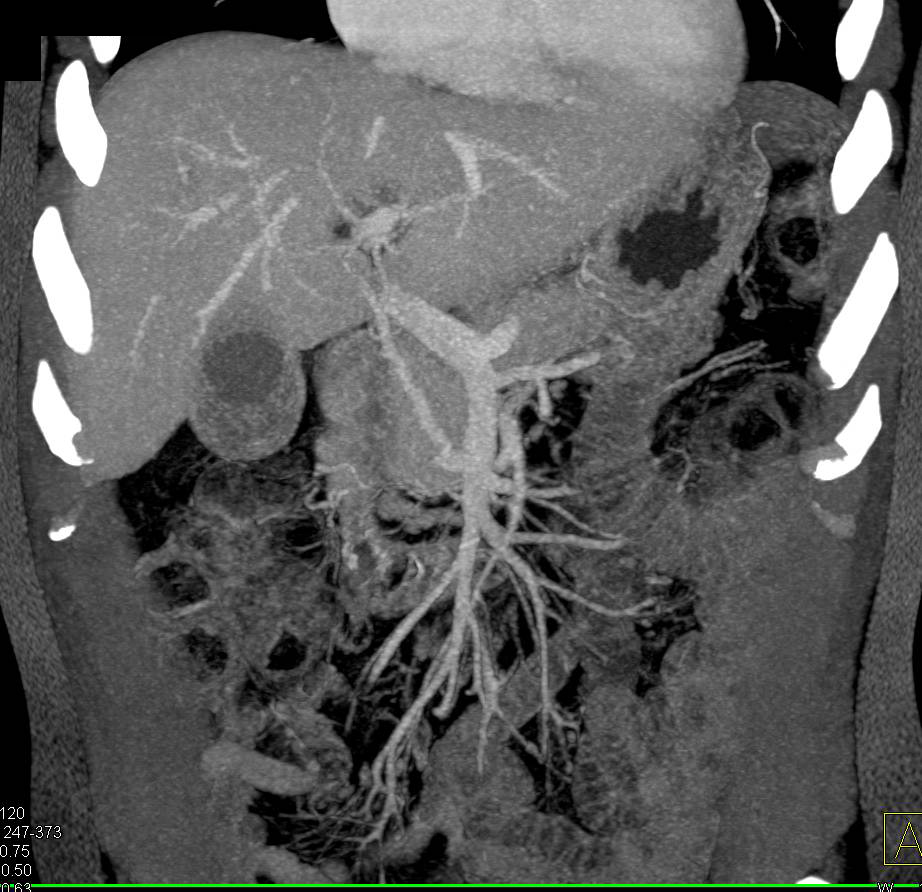 CTA Shows Variant Vascular Anatomy with Single Trunk for Celiac and Superior Mesenteric Artery (SMA) with Low Rising Hepatic Artery in this Patient with Pancreatic Cancer - CTisus CT Scan