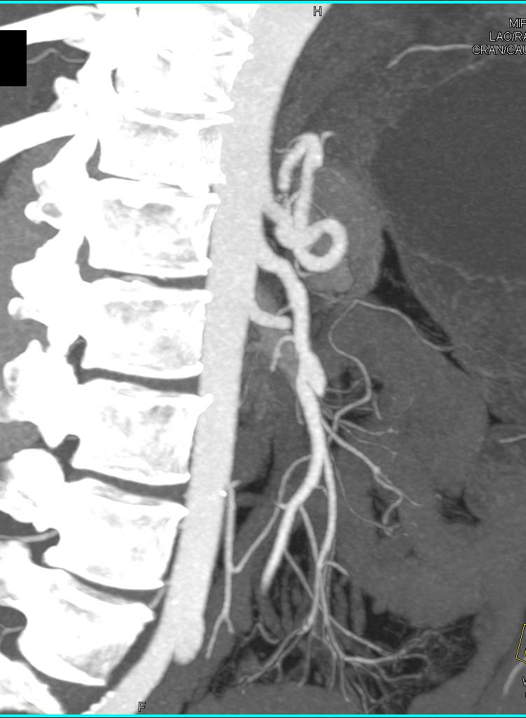 Superior Mesenteric Artery (SMA) Dissection - CTisus CT Scan