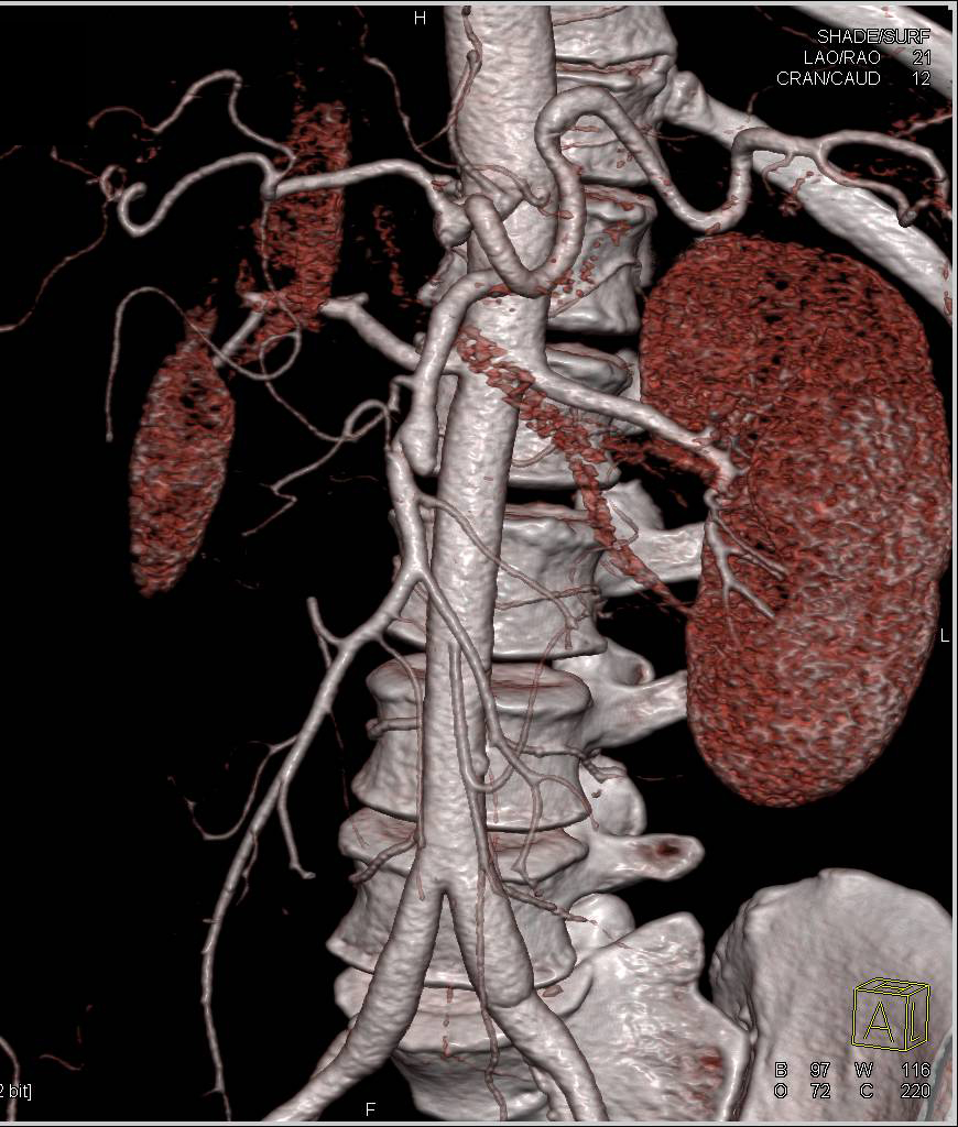 SMA Dissection - Vascular Case Studies - CTisus CT Scanning
