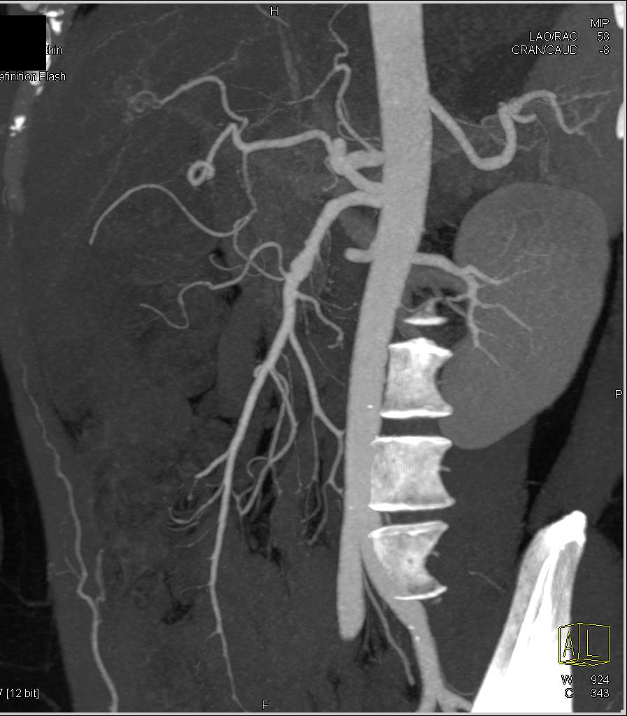 Focal Aneurysm and Dissection in the SMA - CTisus CT Scan