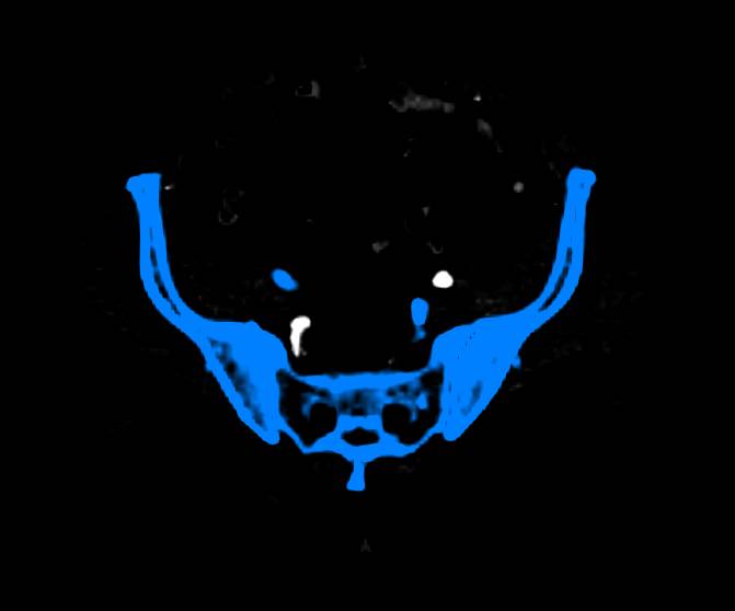 Automated Bone Removal for Lower Extremity CTA - CTisus CT Scan