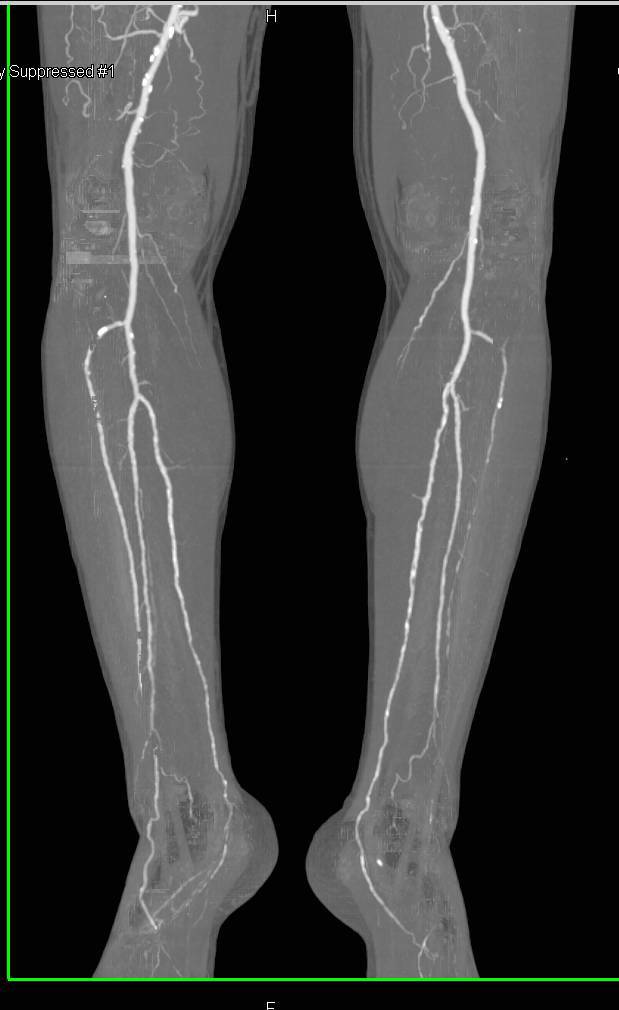 CTA Runoff with Occlusion of the Right Superficial Femoral Artery (SFA