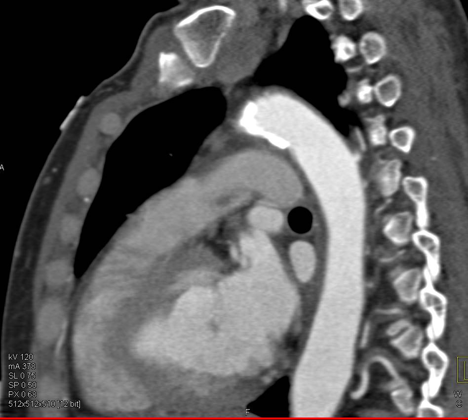 Ulcerating Plaque in the Thoracic Aorta - CTisus CT Scan