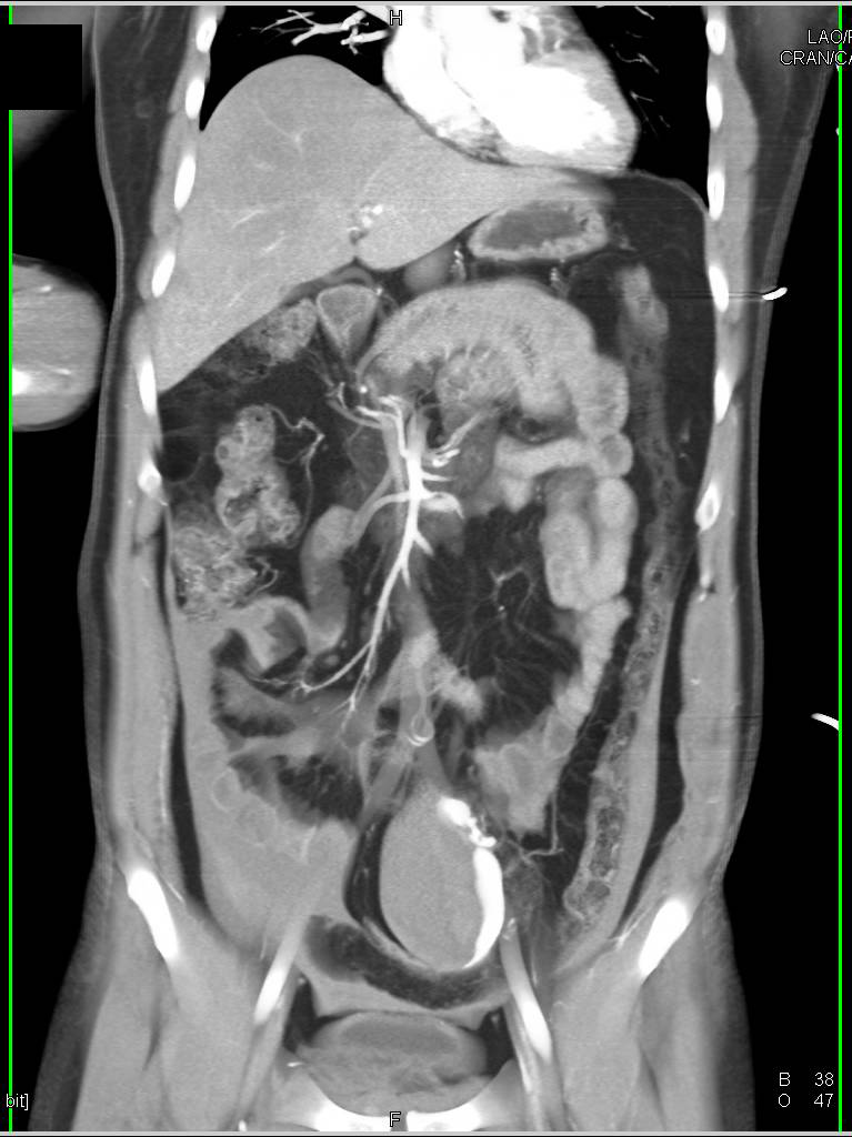 Active Bleed From a Mesenteric Artery with Hemoperitoneum in a Trauma Patient - CTisus CT Scan