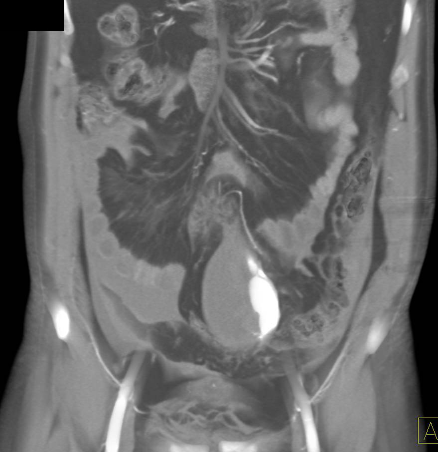 Dissection Abdominal Aorta with Hemoperitoneum - CTisus CT Scan