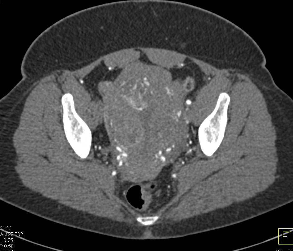 CTA with Occlusion of Right Common Iliac Artery - CTisus CT Scan