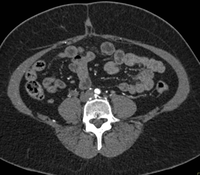 CTA with Occlusion of Right Common Iliac Artery with Collaterals - CTisus CT Scan