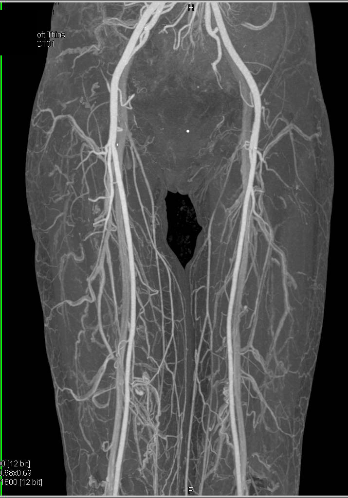 Normal CTA Runoff - CTisus CT Scan