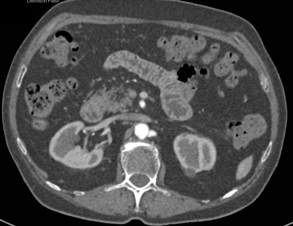 Duplicated Inferior Vena Cava (IVC) From Level of Renal Veins - CTisus CT Scan