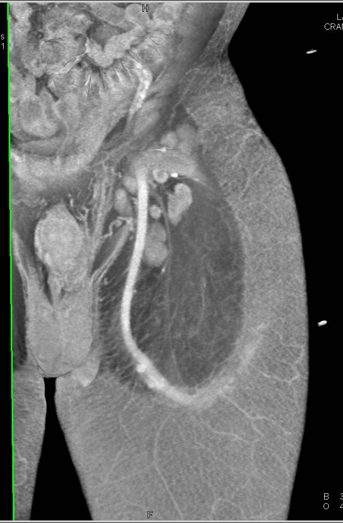 Patent Arteriovenous (AV) Fistulae in Thigh in an End Stage Renal Disease (ESRD) Patient - CTisus CT Scan