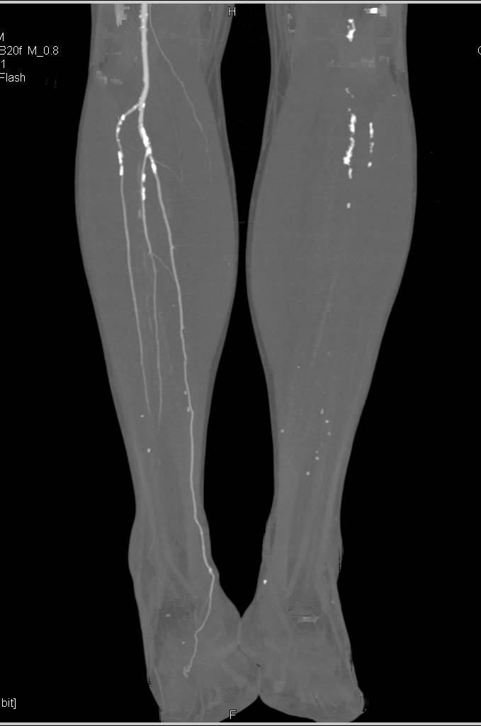 CTA Runoff with Occlusion of Left Fem-Popliteal Graft and Severe Peripheral Vascular Disease (PVD) Bilaterally - CTisus CT Scan