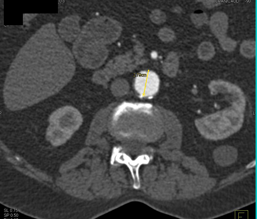 CTA Runoff with Occlusion of Left Fem-Popliteal Graft and Severe Peripheral Vascular Disease (PVD) - CTisus CT Scan