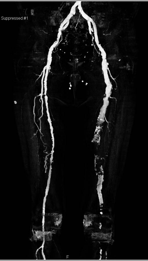 CTA Runoff with Peripheral Vascular Disease (PVD) and Occluded Left Sided Grafts - CTisus CT Scan