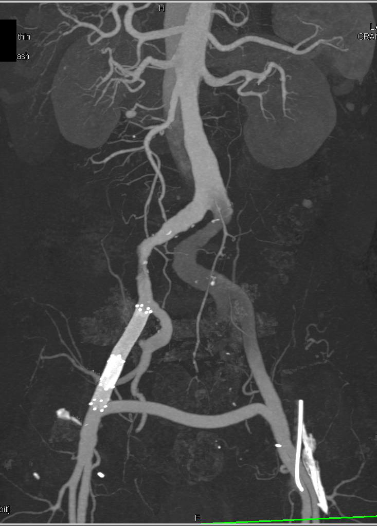 Multiple Aneurysms with Stent Repair and Grafts in Thoracic and Abdominal Aorta - CTisus CT Scan