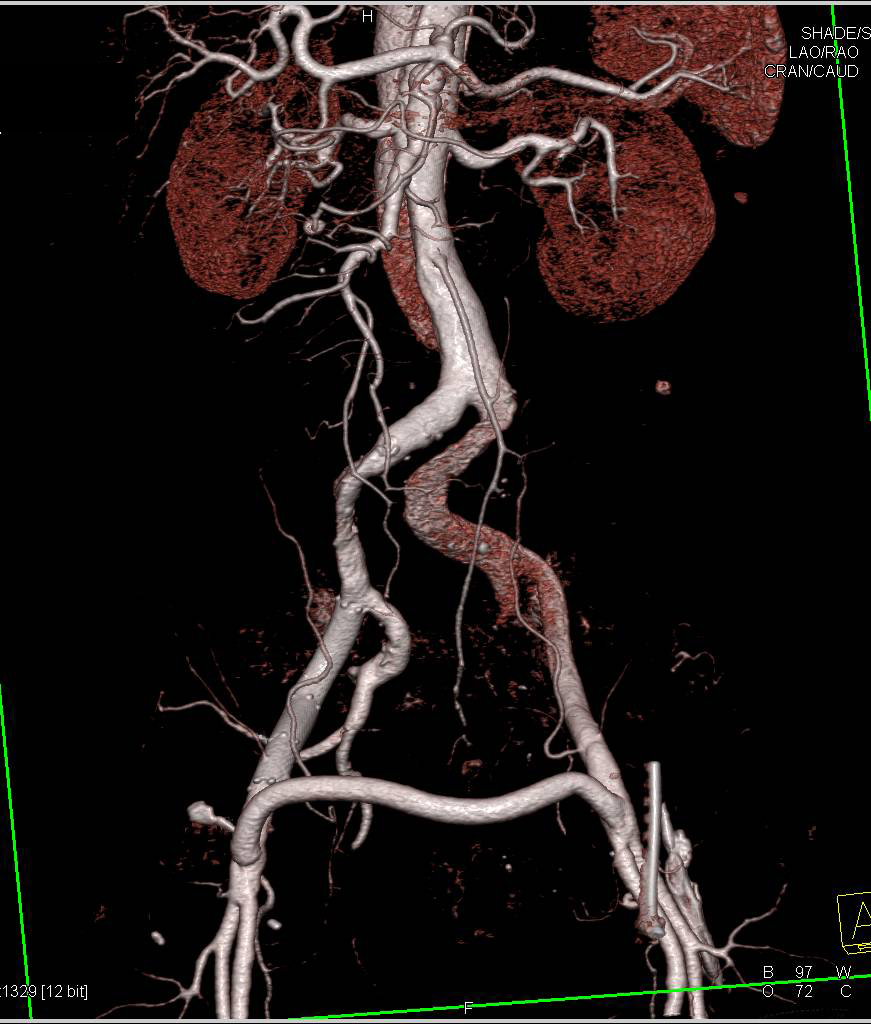 Endovascular Stents with Fem-Fem Bypass - CTisus CT Scan