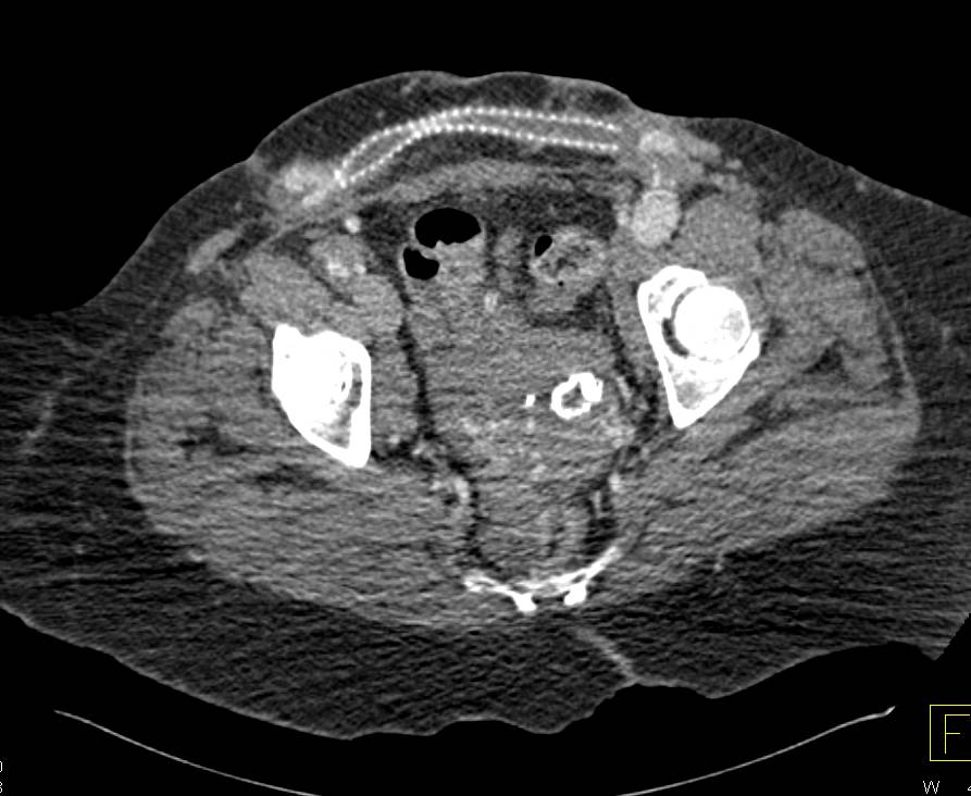 Aortic Dissection with Graft from Lower Thoracic Aorta to Femoral Arteries. Prior Failed Ax-Fem Graft on Right Side - CTisus CT Scan